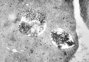 M,24y. | bone marrow - haemolytic anemia M,24y. | bone marrow - haemolytic anemia